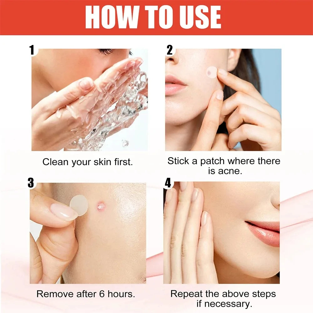 Hydrocolloid Acne Patches — 144 Pack, Ultra-Thin Overnight Treatment