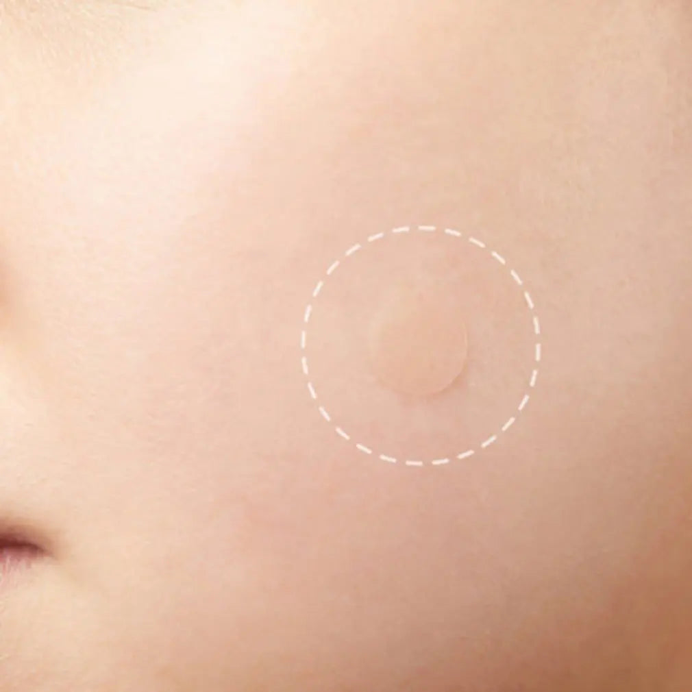Closed Pimple Master Patch — Whitehead and Comedone Treatment