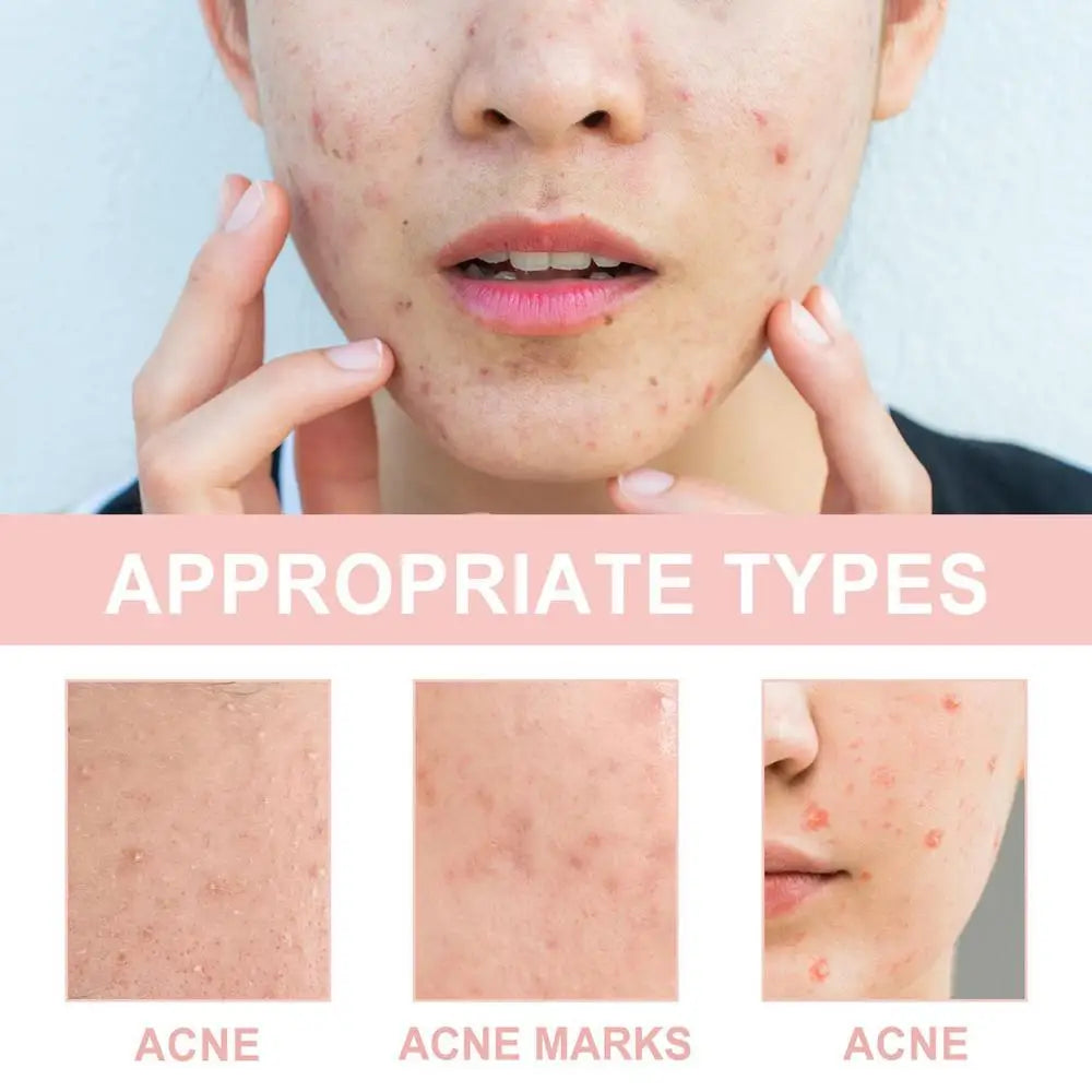 Invisible Hydrocolloid Pimple Patches — Overnight Blemish Treatment