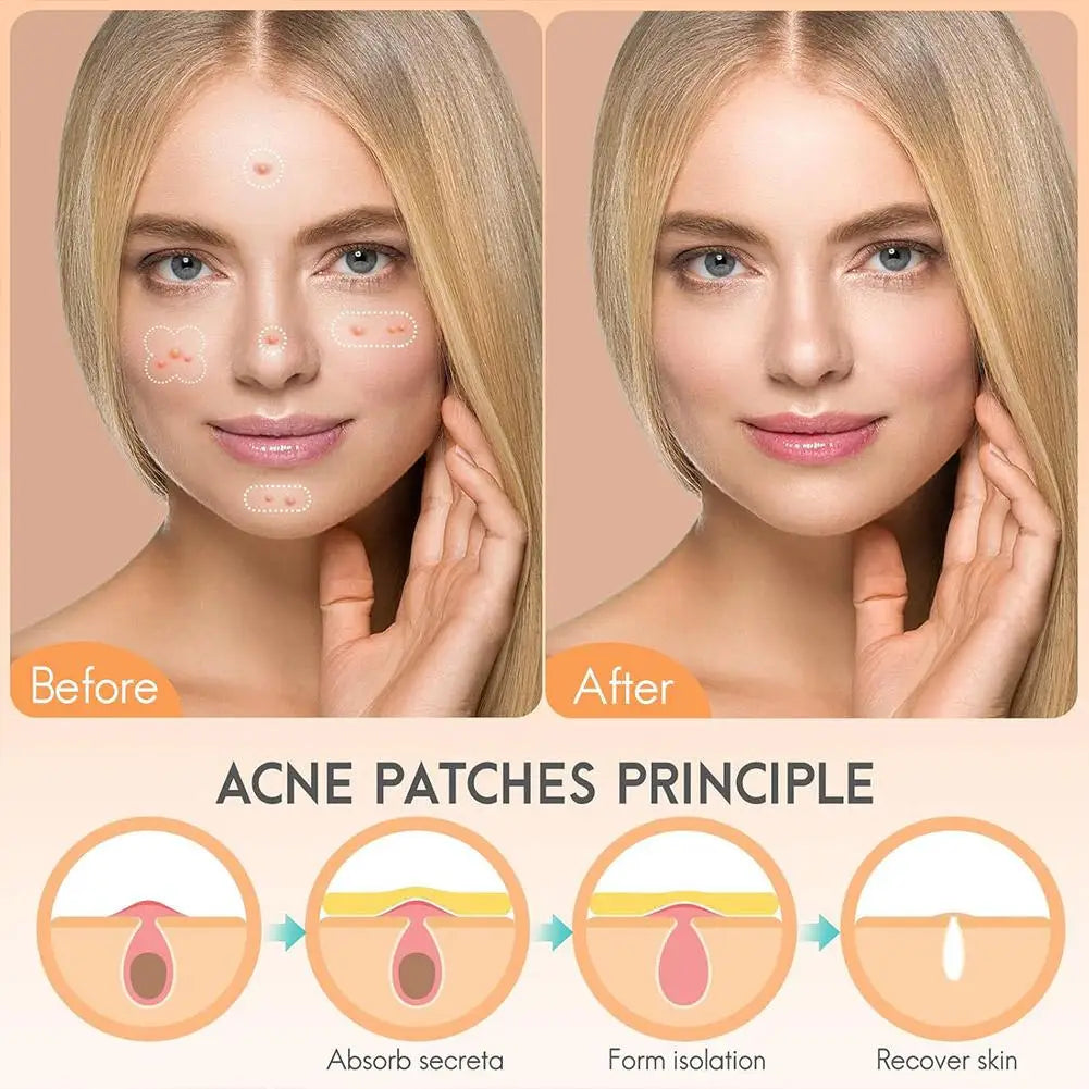 Large-Capacity Pimple Patch Set — Multi-Size Hydrocolloid Value Pack