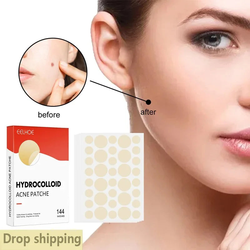 Hydrocolloid Acne Patches — 144 Pack, Ultra-Thin Overnight Treatment