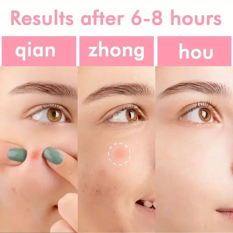 Colorful Hydrocolloid Pimple Patches — Spot Treatment, Fun Colors