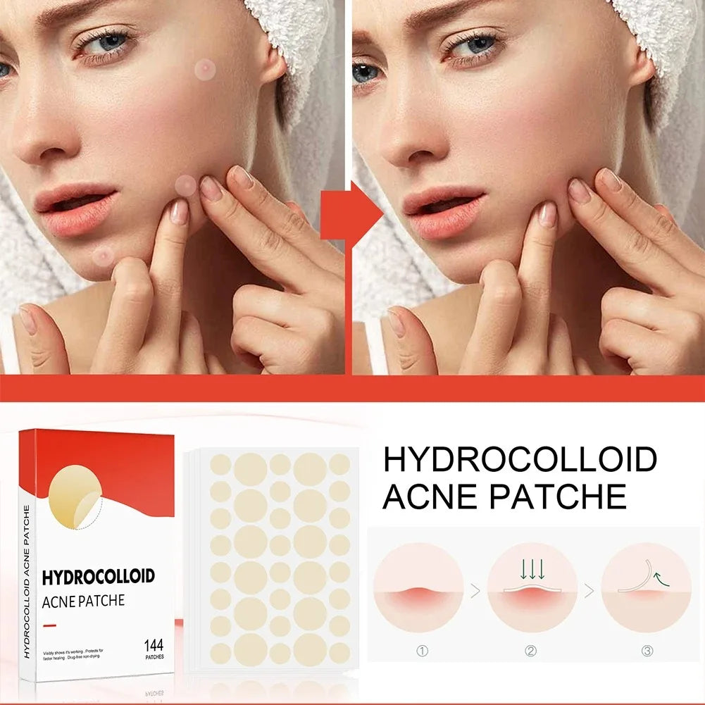 Hydrocolloid Acne Patches — 144 Pack, Ultra-Thin Overnight Treatment