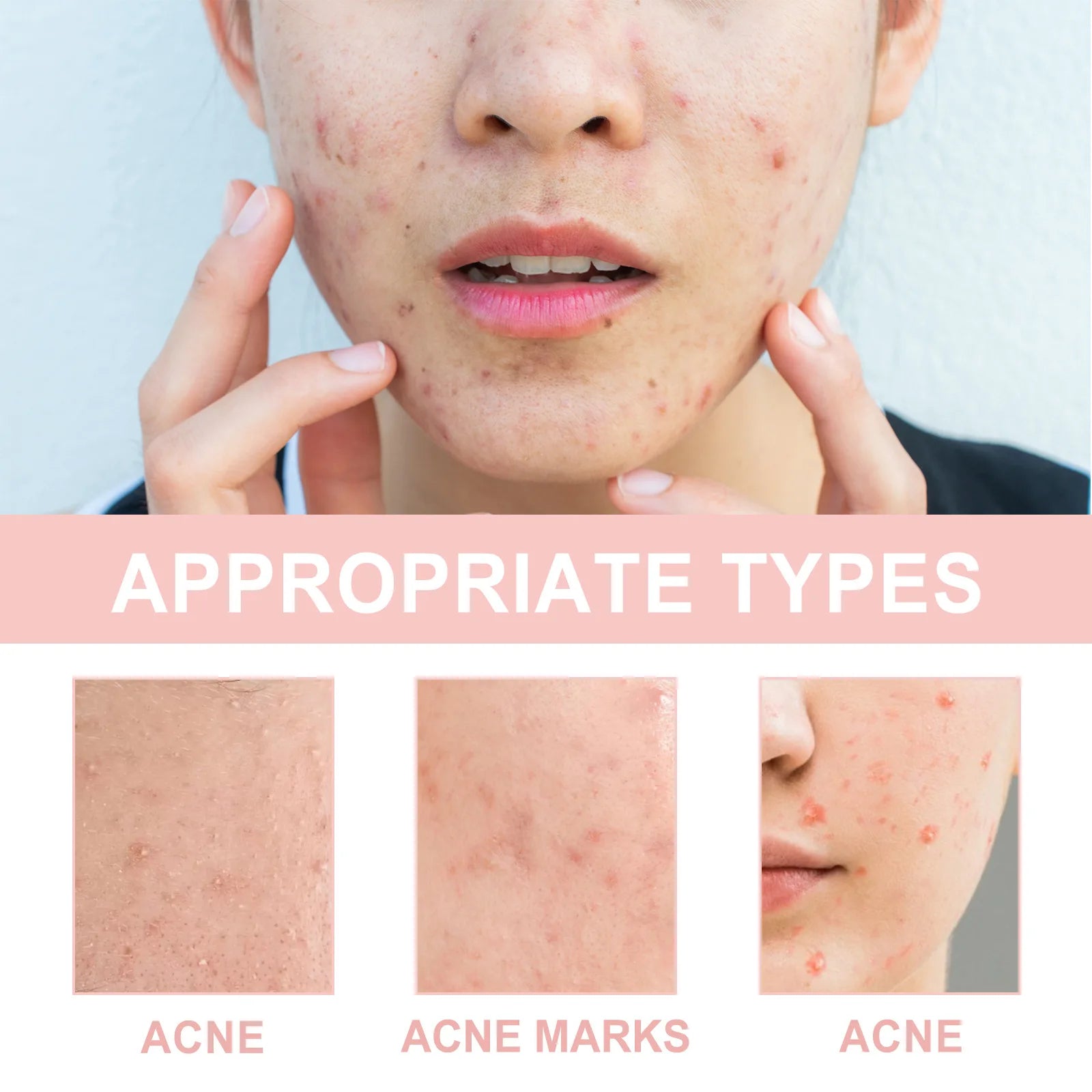Hydrocolloid Face Patches for Pimples — Targeted Blemish Treatment