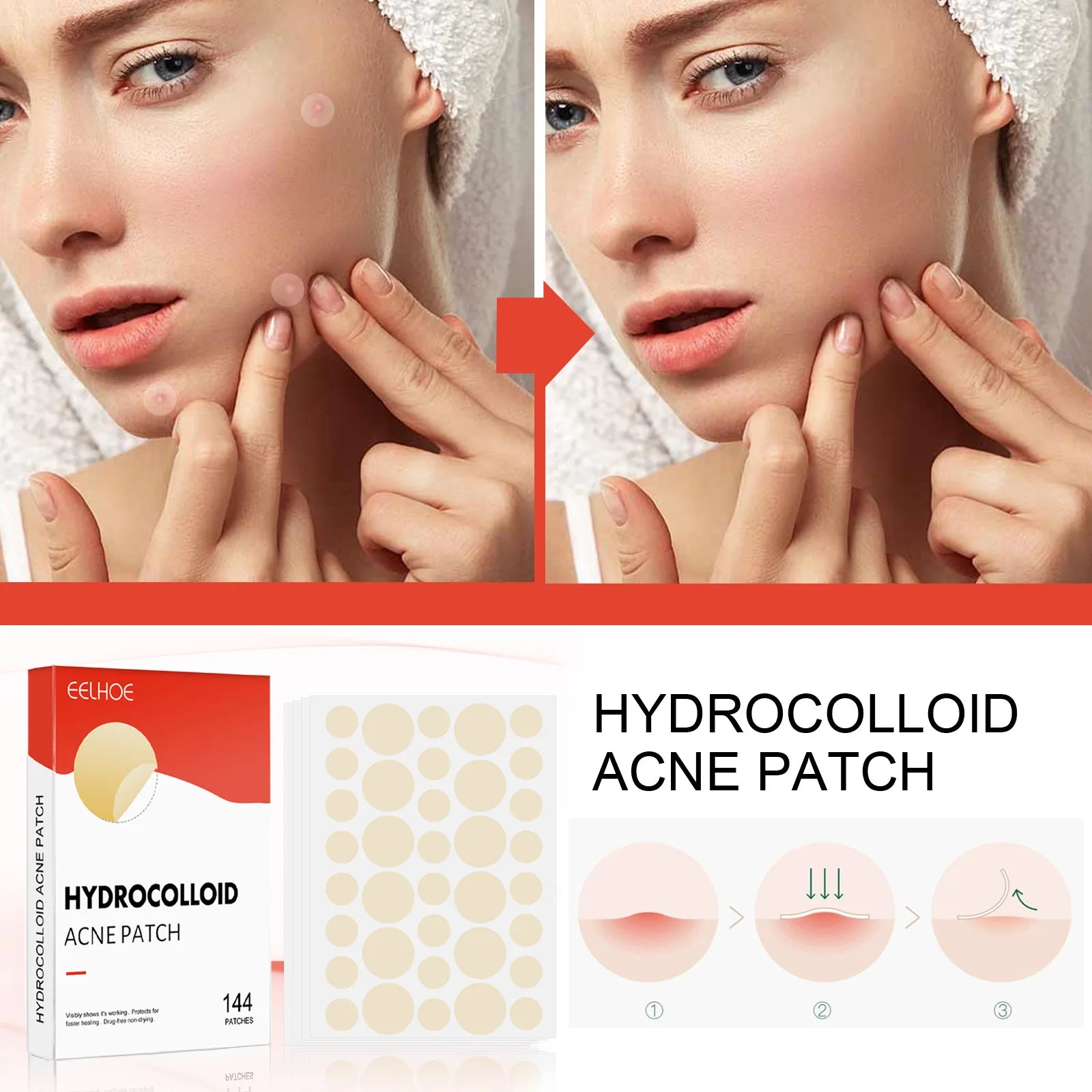 Hydrocolloid Acne Patches — 144 Pack, Ultra-Thin Overnight Treatment