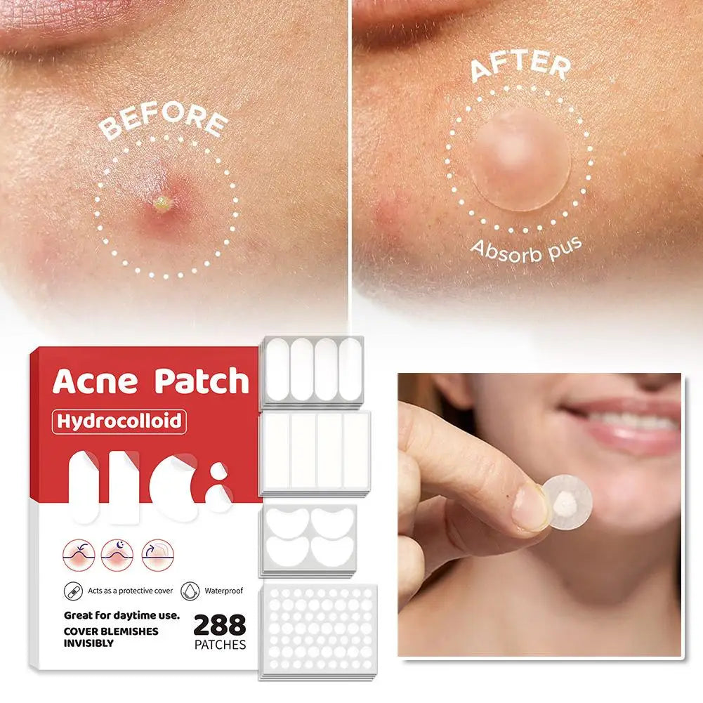 Large-Capacity Pimple Patch Set — Multi-Size Hydrocolloid Value Pack